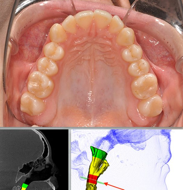 Expertos en Medicina Dental del Sueño: tratamiento del ronquido y de la Apnea/Hipopnea Obstructiva del Sueño (SAHOS)